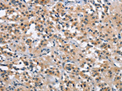 The image on the left is immunohistochemistry of paraffin-embedded Human thyroid cancer tissue using the antibody Antibody) at dilution 1/40, on the right is treated with synthetic peptide. (Original magnification: ×200)