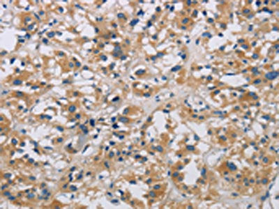 The image is immunohistochemistry of paraffin-embedded Human thyroid cancer tissue using ARF6 Antibody(ARF6 Antibody) at dilution 1/20. (Original magnification: ×200)Rabbit anti-Human ARF6 Polyclonal Antibody