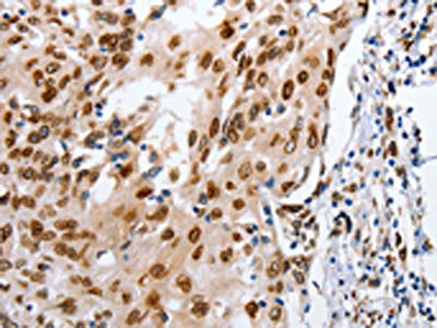The image on the left is immunohistochemistry of paraffin-embedded Human cervical cancer tissue using MUTYH Antibody(MUTYH Antibody) at dilution 1/25, on the right is treated with fusion protein. (Original magnification: ×200)Rabbit anti-Human MUTYH Polyclonal Antibody