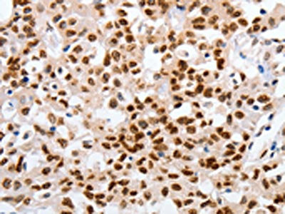 The image on the left is immunohistochemistry of paraffin-embedded Human lung cancer tissue using the antibody Antibody) at dilution 1/25, on the right is treated with fusion protein. (Original magnification: ×200)Rabbit anti-Human MUTYH Polyclonal Antibody