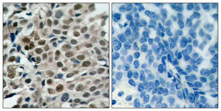 Immunohistochemical analysis of paraffin-embedded human breast carcinoma tissue using FKHRL1 (phospho-Ser253) antibody.Rabbit anti-Human FOXO3 Polyclonal Antibody