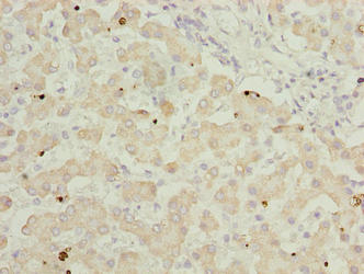 Immunohistochemistry of paraffin-embedded human liver tissue using GOT2 Antibody at dilution of 1:100Rabbit anti-Human GOT2 Polyclonal Antibody