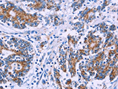 The image on the left is immunohistochemistry of paraffin-embedded Human colon cancer tissue using AGFG1 Antibody(AGFG1 Antibody) at dilution 1/50, on the right is treated with fusion protein. (Original magnification: ×200)Rabbit anti-Human AGFG1 Polyclonal Antibody