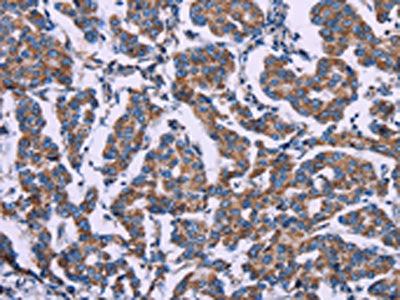 The image on the left is immunohistochemistry of paraffin-embedded Human breast cancer tissue using the antibody Antibody) at dilution 1/50, on the right is treated with fusion protein. (Original magnification: ×200)Rabbit anti-Human AGFG1 Polyclonal Antibody