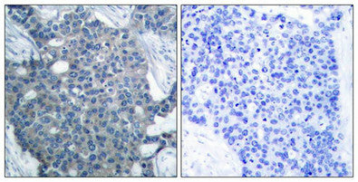 Immunohistochemical analysis of paraffin-embedded human breast carcinoma tissue using Stathmin 1(Ab-25) Antibody(left) or the same antibody preincubated with blocking peptide(right).Rabbit anti-Human STMN1 Polyclonal Antibody