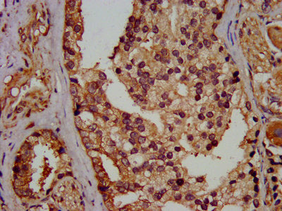 IHC image of the antibody diluted at 1:400 and staining in paraffin-embedded human prostate cancer performed on a Leica BondTM system. After dewaxing and hydration, antigen retrieval was mediated by high pressure in a citrate buffer (pH 6.0). Section was blocked with 10% normal goat serum 30min at RT. Then primary antibody (1% BSA) was incubated at 4°C overnight. The primary is detected by a biotinylated secondary antibody and visualized using an HRP conjugated SP system.Rabbit anti-Human EIF3G Polyclonal Antibody