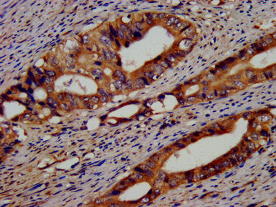 IHC image of EIF3G Antibody diluted at 1:400 and staining in paraffin-embedded human colon cancer performed on a Leica BondTM system. After dewaxing and hydration, antigen retrieval was mediated by high pressure in a citrate buffer (pH 6.0). Section was blocked with 10% normal goat serum 30min at RT. Then primary antibody (1% BSA) was incubated at 4°C overnight. The primary is detected by a biotinylated secondary antibody and visualized using an HRP conjugated SP system.Rabbit anti-Human EIF3G Polyclonal Antibody