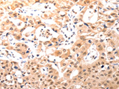 The image on the left is immunohistochemistry of paraffin-embedded Human lung cancer tissue using BDKRB2 Antibody(BDKRB2 Antibody) at dilution 1/50, on the right is treated with synthetic peptide. (Original magnification: ×200)