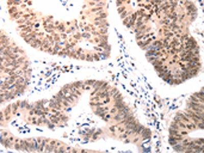 The image on the left is immunohistochemistry of paraffin-embedded Human colon cancer tissue using the antibody Antibody) at dilution 1/50, on the right is treated with synthetic peptide. (Original magnification: ×200)