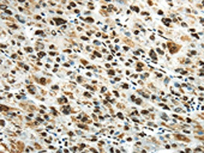 The image on the left is immunohistochemistry of paraffin-embedded Human liver cancer tissue using HNRNPM Antibody(HNRNPM Antibody) at dilution 1/25, on the right is treated with synthetic peptide. (Original magnification: ×200)Rabbit anti-Human HNRNPM Polyclonal Antibody
