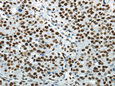 The image on the left is immunohistochemistry of paraffin-embedded Human breast cancer tissue using the antibody Antibody) at dilution 1/25, on the right is treated with synthetic peptide. (Original magnification: ×200)Rabbit anti-Human HNRNPM Polyclonal Antibody
