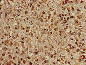 Immunohistochemistry of paraffin-embedded human glioma using HSPA8 Antibody at dilution of 1:100Rabbit anti-Human HSPA8 Polyclonal Antibody