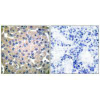 Immunohistochemical analysis of paraffin-embedded human breast carcinoma tissue using Transglutaminase 2 antibody.Rabbit anti-Human TGM2 Polyclonal Antibody