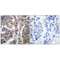 Immunohistochemical analysis of paraffin-embedded human breast carcinoma tissue using Keratin 20 antibody.