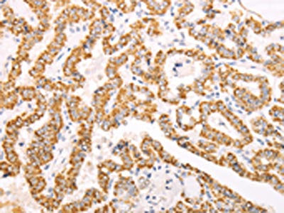 The image on the left is immunohistochemistry of paraffin-embedded Human thyroid cancer tissue using the antibody Antibody) at dilution 1/60, on the right is treated with fusion protein. (Original magnification: ×200)