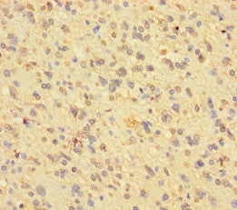 Immunohistochemistry of paraffin-embedded human glioma using BMI1 Antibody at dilution of 1:100