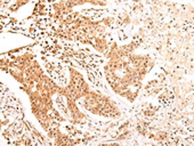 The image on the left is immunohistochemistry of paraffin-embedded Human colorectal cancer tissue using ALDH3A2 Antibody(ALDH3A2 Antibody) at dilution 1/20, on the right is treated with fusion protein. (Original magnification: ×200)Rabbit anti-Human ALDH3A2 Polyclonal Antibody
