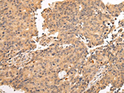 The image on the left is immunohistochemistry of paraffin-embedded Human prostate cancer tissue using the antibody Antibody) at dilution 1/20, on the right is treated with fusion protein. (Original magnification: ×200)Rabbit anti-Human ALDH3A2 Polyclonal Antibody