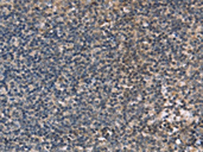 The image on the left is immunohistochemistry of paraffin-embedded Human tonsil tissue using OTC Antibody(OTC Antibody) at dilution 1/40, on the right is treated with fusion protein. (Original magnification: ×200)Rabbit anti-Human OTC Polyclonal Antibody