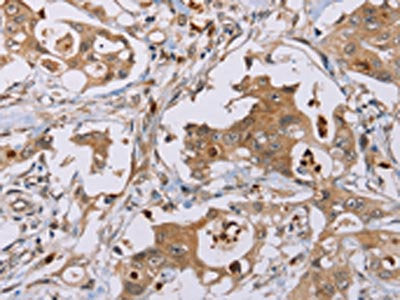 The image on the left is immunohistochemistry of paraffin-embedded Human colon cancer tissue using the antibody Antibody) at dilution 1/40, on the right is treated with fusion protein. (Original magnification: ×200)Rabbit anti-Human OTC Polyclonal Antibody