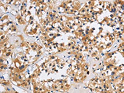 The image on the left is immunohistochemistry of paraffin-embedded Human thyroid cancer tissue using ITGA11 Antibody(ITGA11 Antibody) at dilution 1/40, on the right is treated with synthetic peptide. (Original magnification: ×200)