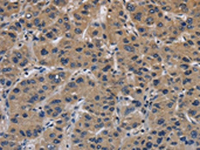 The image on the left is immunohistochemistry of paraffin-embedded Human liver cancer tissue using the antibody Antibody) at dilution 1/40, on the right is treated with synthetic peptide. (Original magnification: ×200)