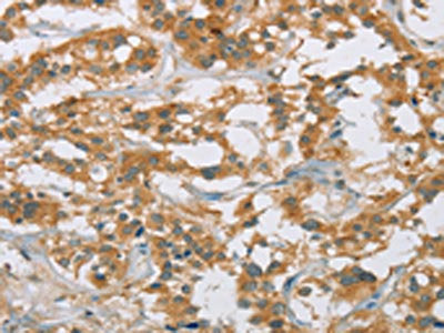 The image on the left is immunohistochemistry of paraffin-embedded Human thyroid cancer tissue using CYP27A1 Antibody(CYP27A1 Antibody) at dilution 1/25, on the right is treated with fusion protein. (Original magnification: ×200)Rabbit anti-Human CYP27A1 Polyclonal Antibody