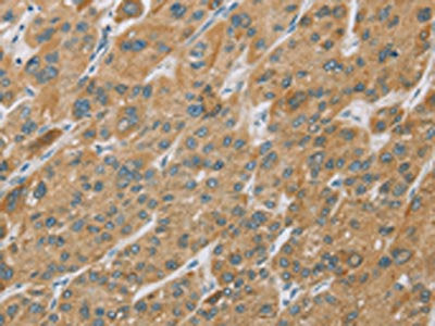 The image on the left is immunohistochemistry of paraffin-embedded Human liver cancer tissue using the antibody Antibody) at dilution 1/25, on the right is treated with fusion protein. (Original magnification: ×200)Rabbit anti-Human CYP27A1 Polyclonal Antibody