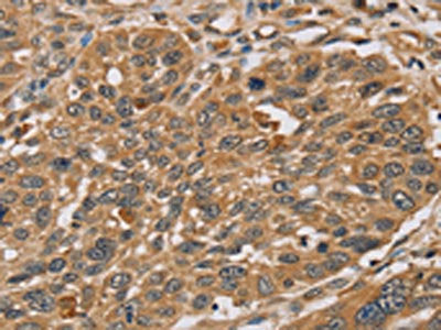 The image on the left is immunohistochemistry of paraffin-embedded Human lung cancer tissue using RNF5 Antibody(RNF5 Antibody) at dilution 1/35, on the right is treated with synthetic peptide. (Original magnification: ×200)Rabbit anti-Human RNF5 Polyclonal Antibody