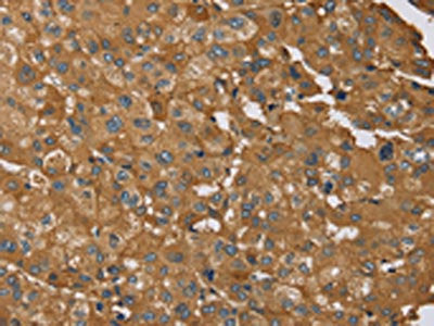 The image on the left is immunohistochemistry of paraffin-embedded Human liver cancer tissue using the antibody Antibody) at dilution 1/35, on the right is treated with synthetic peptide. (Original magnification: ×200)Rabbit anti-Human RNF5 Polyclonal Antibody