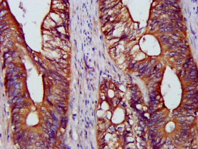 IHC image of BCAP31 Antibody diluted at 1:1200 and staining in paraffin-embedded human colon cancer performed on a Leica BondTM system. After dewaxing and hydration, antigen retrieval was mediated by high pressure in a citrate buffer (pH 6.0). Section was blocked with 10% normal goat serum 30min at RT. Then primary antibody (1% BSA) was incubated at 4°C overnight. The primary is detected by a biotinylated secondary antibody and visualized using an HRP conjugated SP system.