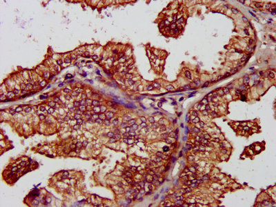 IHC image of BCAP31 Antibody diluted at 1:1200 and staining in paraffin-embedded human prostate cancer performed on a Leica BondTM system. After dewaxing and hydration, antigen retrieval was mediated by high pressure in a citrate buffer (pH 6.0). Section was blocked with 10% normal goat serum 30min at RT. Then primary antibody (1% BSA) was incubated at 4°C overnight. The primary is detected by a biotinylated secondary antibody and visualized using an HRP conjugated SP system.