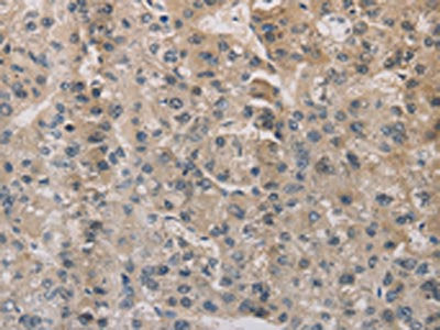 The image on the left is immunohistochemistry of paraffin-embedded Human liver cancer tissue using ESRRG Antibody(ESRRG Antibody) at dilution 1/30, on the right is treated with fusion protein. (Original magnification: ×200)Rabbit anti-Human ESRRG Polyclonal Antibody