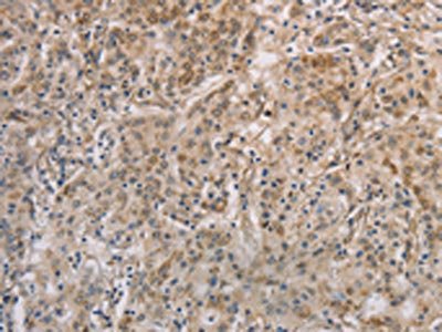 The image on the left is immunohistochemistry of paraffin-embedded Human gastic cancer tissue using the antibody Antibody) at dilution 1/30, on the right is treated with fusion protein. (Original magnification: ×200)Rabbit anti-Human ESRRG Polyclonal Antibody