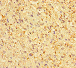 Immunohistochemistry of paraffin-embedded human glioma using ZNF384 Antibody at dilution of 1:100