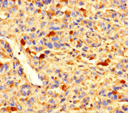 Immunohistochemistry of paraffin-embedded human melanoma using ZNF384 Antibody at dilution of 1:100