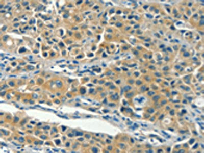 The image on the left is immunohistochemistry of paraffin-embedded Human lung cancer tissue using KLC1 Antibody(KLC1 Antibody) at dilution 1/40, on the right is treated with fusion protein. (Original magnification: ×200)Rabbit anti-Human KLC1 Polyclonal Antibody