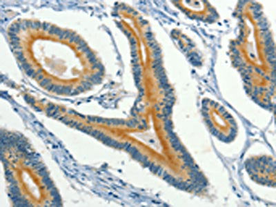 The image on the left is immunohistochemistry of paraffin-embedded Human colon cancer tissue using the antibody Antibody) at dilution 1/40, on the right is treated with fusion protein. (Original magnification: ×200)