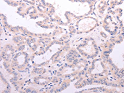 The image on the left is immunohistochemistry of paraffin-embedded Human thyroid cancer tissue using the antibody Antibody) at dilution 1/15, on the right is treated with fusion protein. (Original magnification: ×200)