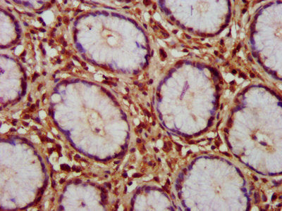 IHC image of HAX1 Antibody diluted at 1:150 and staining in paraffin-embedded human gastric cancer performed on a Leica BondTM system. After dewaxing and hydration, antigen retrieval was mediated by high pressure in a citrate buffer (pH 6.0). Section was blocked with 10% normal goat serum 30min at RT. Then primary antibody (1% BSA) was incubated at 4°C overnight. The primary is detected by a biotinylated secondary antibody and visualized using an HRP conjugated SP system.Rabbit anti-Human HAX1 Polyclonal Antibody