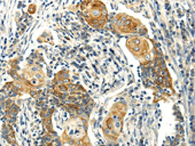 The image on the left is immunohistochemistry of paraffin-embedded Human cervical cancer tissue using MSI1 Antibody(MSI1 Antibody) at dilution 1/30, on the right is treated with synthetic peptide. (Original magnification: ×200)Rabbit anti-Human MSI1 Polyclonal Antibody