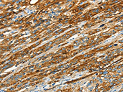 The image on the left is immunohistochemistry of paraffin-embedded Human esophagus cancer tissue using the antibody Antibody) at dilution 1/40, on the right is treated with synthetic peptide. (Original magnification: ×200)