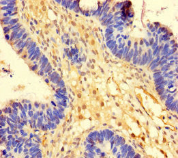 Immunohistochemistry of paraffin-embedded human ovarian cancer using OTUB1 Antibody at dilution of 1:100Rabbit anti-Human OTUB1 Polyclonal Antibody
