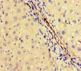 Immunohistochemistry of paraffin-embedded human liver cancer using OTUB1 Antibody at dilution of 1:100Rabbit anti-Human OTUB1 Polyclonal Antibody