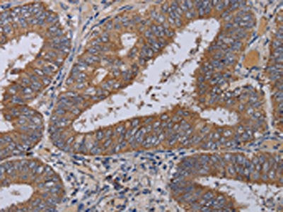 The image on the left is immunohistochemistry of paraffin-embedded Human colon cancer tissue using the antibody Antibody) at dilution 1/40, on the right is treated with fusion protein. (Original magnification: ×200)Rabbit anti-Human ZC3H12A Polyclonal Antibody