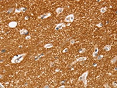 The image on the left is immunohistochemistry of paraffin-embedded Human brain  tissue using SLC25A13 Antibody(SLC25A13 Antibody) at dilution 1/35, on the right is treated with fusion protein. (Original magnification: ×200)Rabbit anti-Human SLC25A13 Polyclonal Antibody