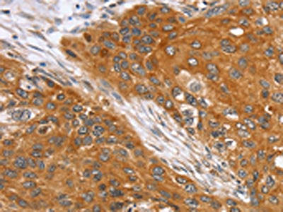 The image on the left is immunohistochemistry of paraffin-embedded Human esophagus cancer tissue using the antibody Antibody) at dilution 1/35, on the right is treated with fusion protein. (Original magnification: ×200)Rabbit anti-Human SLC25A13 Polyclonal Antibody