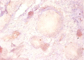 Immunohistochemistry of paraffin-embedded human prostate tissue using PARK7 Antibody at dilution of 1:50Rabbit anti-Human PARK7 Polyclonal Antibody