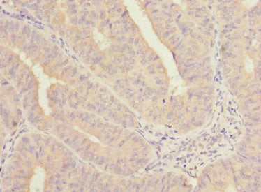 Immunohistochemistry of paraffin-embedded human endometrial cancer using NELFB Antibody at dilution of 1:100Rabbit anti-Human NELFB Polyclonal Antibody