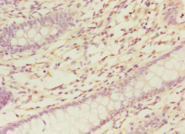 Immunohistochemistry of paraffin-embedded human colon cancer using NELFB Antibody at dilution of 1:100Rabbit anti-Human NELFB Polyclonal Antibody